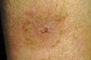 Closed wound after treatment