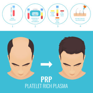 PRP treatment for hair loss