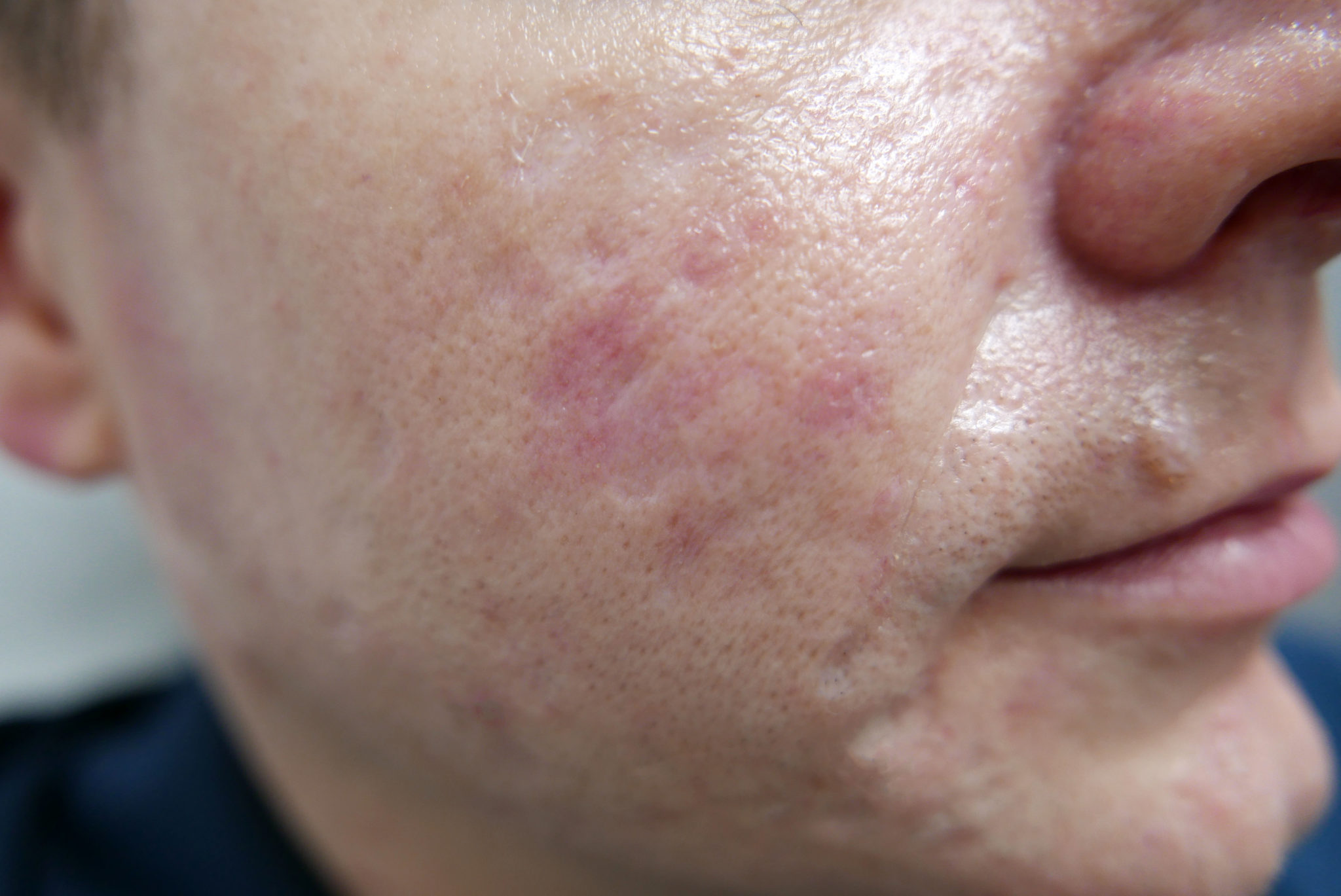 Male with clearer skin after PRP skincare treatment