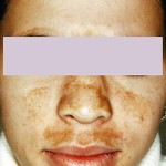 Melasma and Contraception