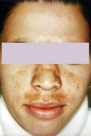 Melasma and Contraception