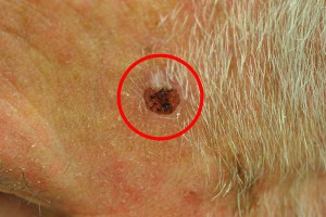 Radiosurgery - Before South Weymouth MA Skin Cancer Treatment