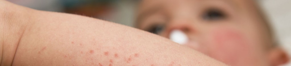 Psoriasis Treatment, South Weymouth MA