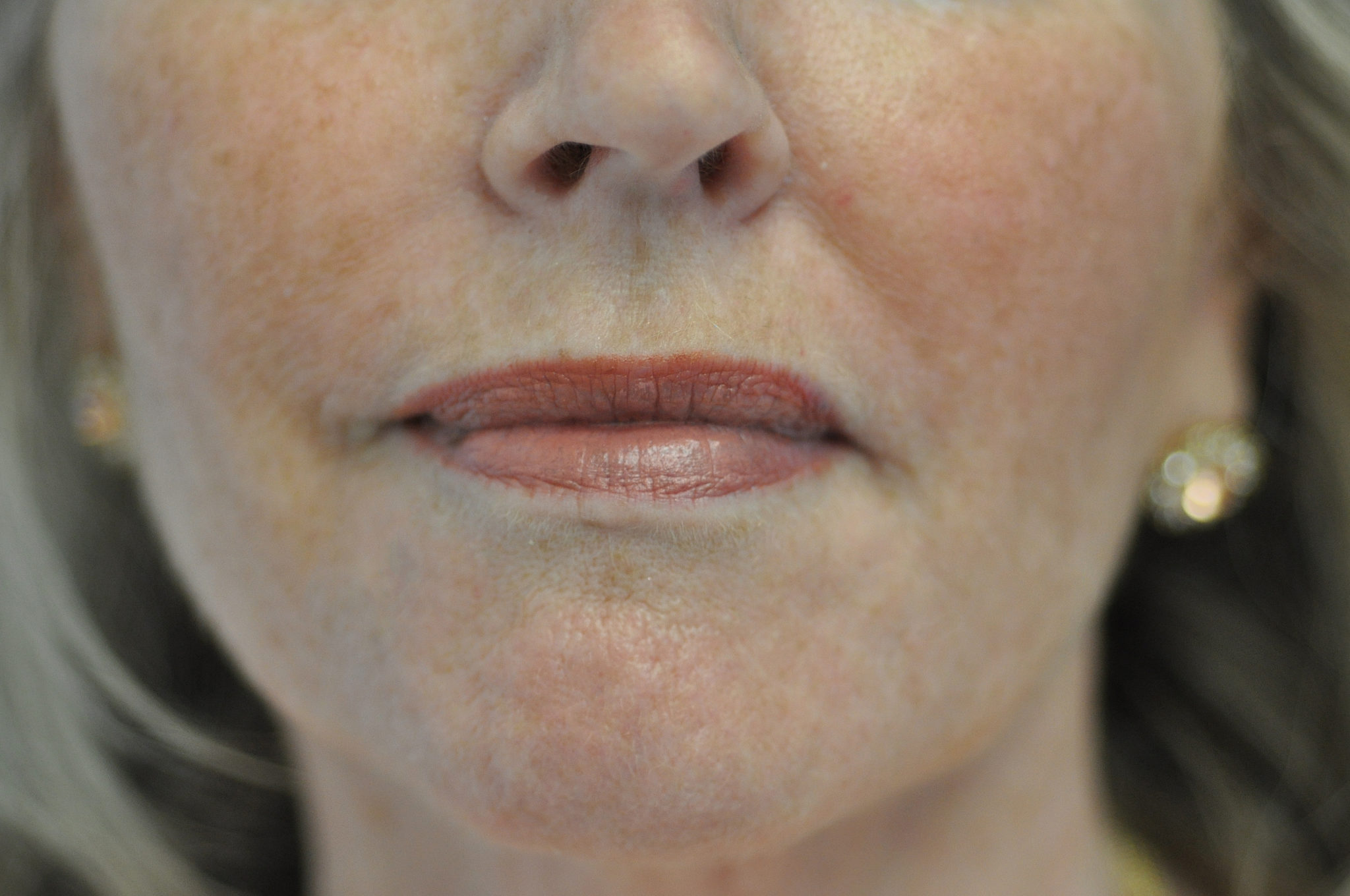 After Cosmetic Filler Treatment in Weymouth MA