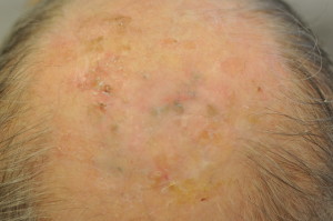 Actinic Keratoses: After