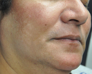 After Melasma Treatment in Weymouth MA