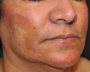 Before Melasma Treatment in South Shore MA