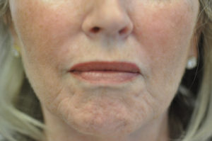 Before Cosmetic Filler Treatment in Weymouth MA