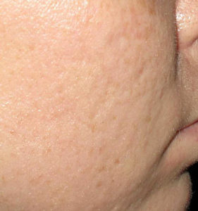 Greater Boston Microneedling procedures