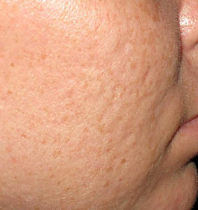 Greater Boston Microneedling procedures