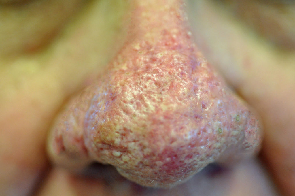 Rhinophyma (Bulbous Nose) Treatment Case 1781 - Gk Dermatology, Pc