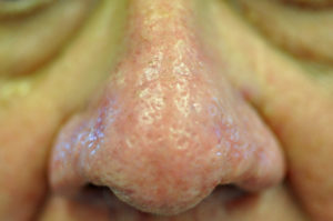 After S Weymouth MA Rhinophyma Treatment