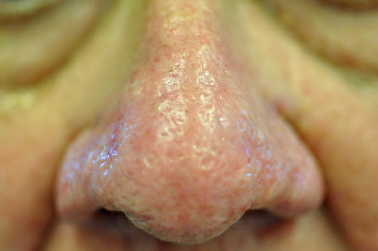 Rhinophyma (Bulbous Nose) Treatment Case 1781 - Gk Dermatology, Pc