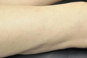 South Shore MA Sclerotherapy treatments