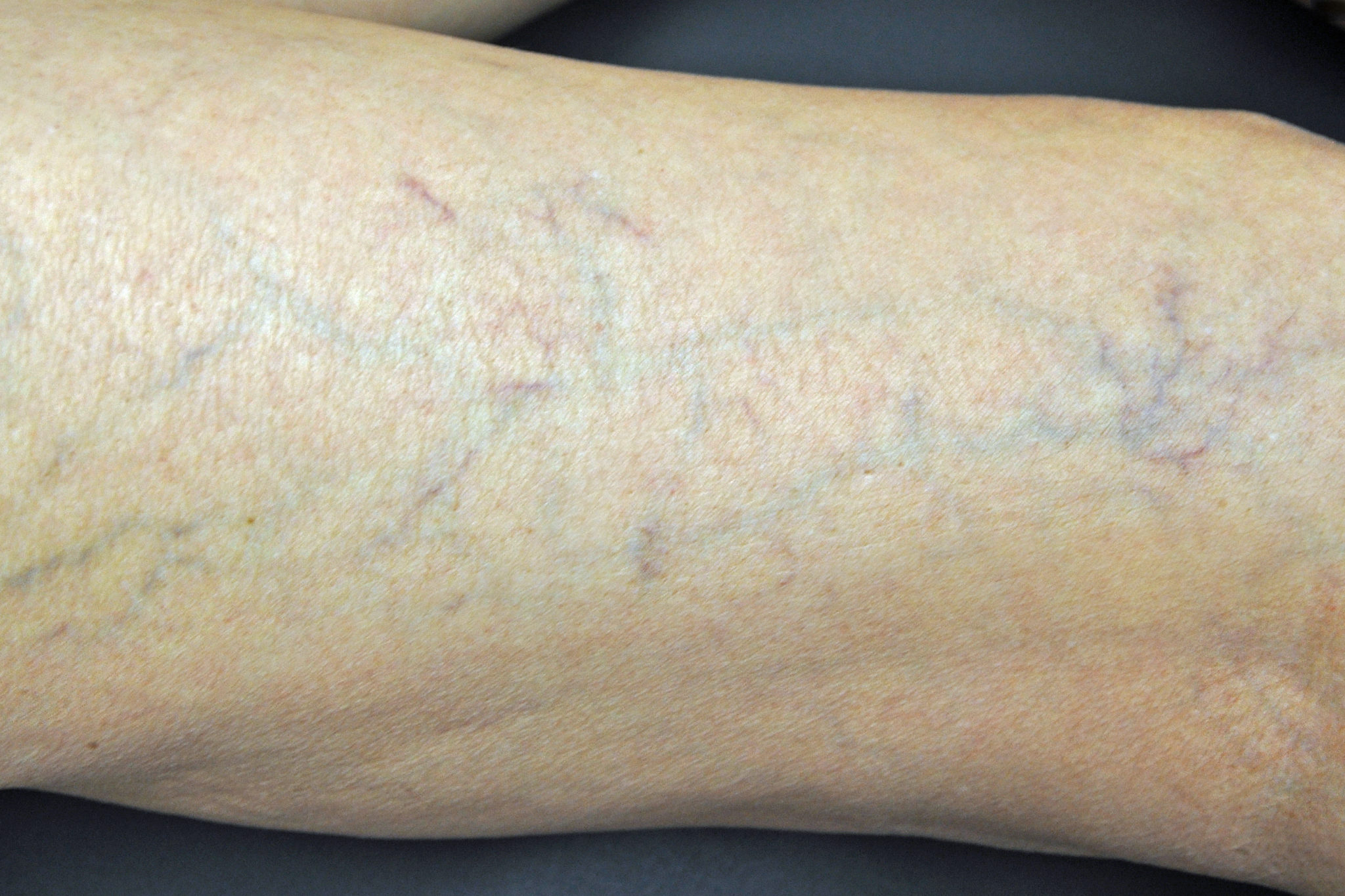 before Sclerotherapy treatments in Weymouth MA
