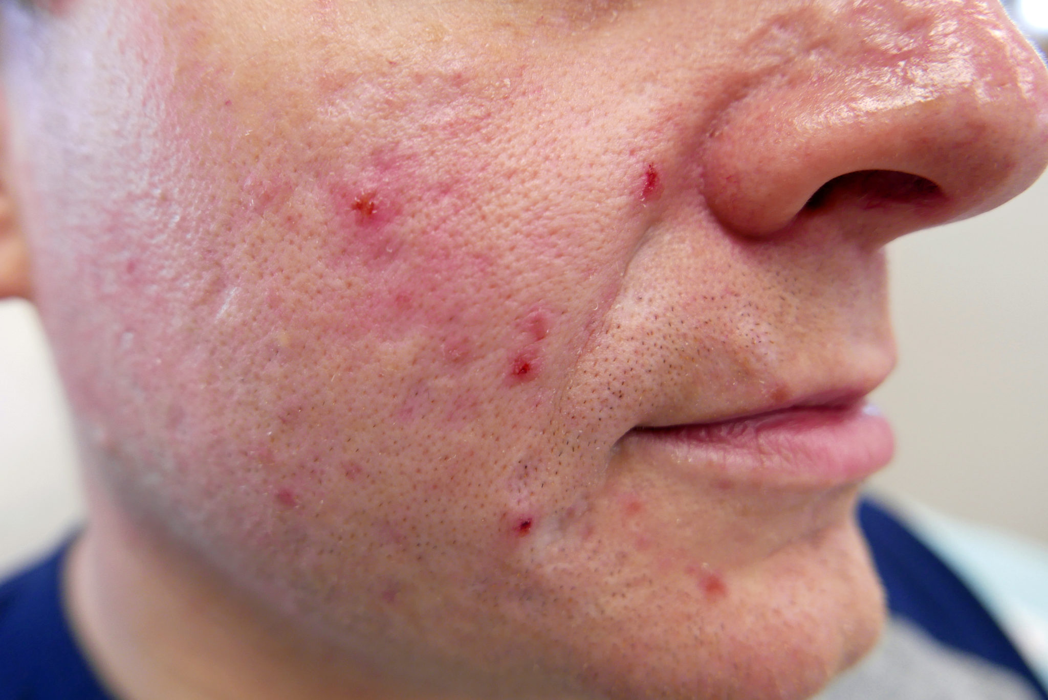 Male with blemished skin before PRP treatment 